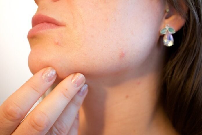 Livre-se da acne: Conheça os tipos e tratamentos para levantar a autoestima (Foto: Kjerstin Michaela Noomi Sakura Gihle Martinsen Haraldsen por Pixabay)