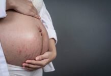 Estrias na gravidez: Como prevenir e tratar antes e depois da gestação Estrias na gravidez: Como prevenir e tratar as estrias antes e depois da gestação (Foto: jcomp/Freepik)