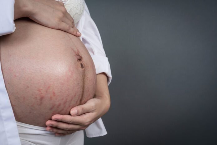 Estrias na gravidez: Como prevenir e tratar as estrias antes e depois da gestação (Foto: jcomp/Freepik)