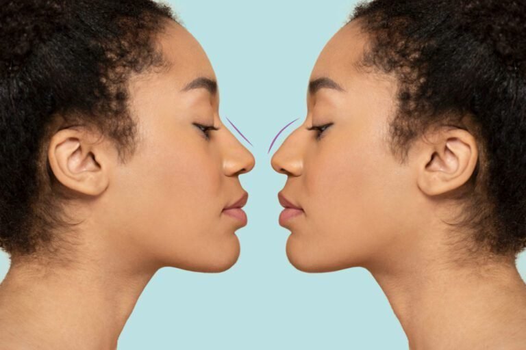 8 correções no nariz que podem ser feitas com a rinoplastia (Foto: Freepik)