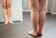 Cirurgia do lipedema ajuda a reduzir dor e proteger joelhos Lipedema pode afetar articulações e exige tratamento precoce (Foto: Divulgação)