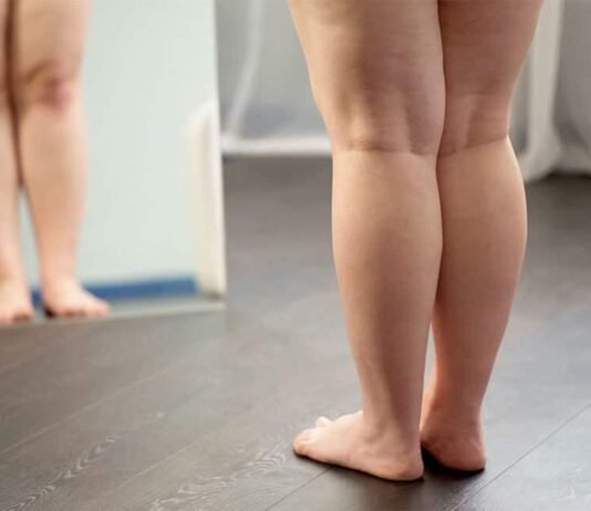 Cirurgia do lipedema ajuda a reduzir dor e proteger joelhos Lipedema pode afetar articulações e exige tratamento precoce (Foto: Divulgação)