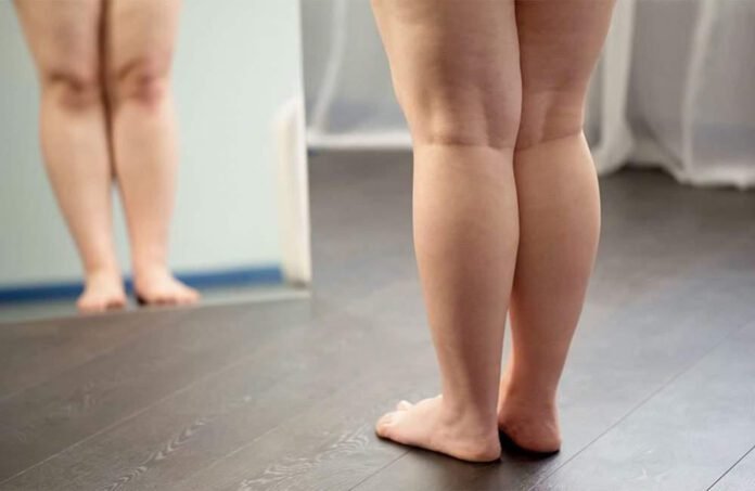 Lipedema pode afetar articulações e exige tratamento precoce (Foto: Divulgação)